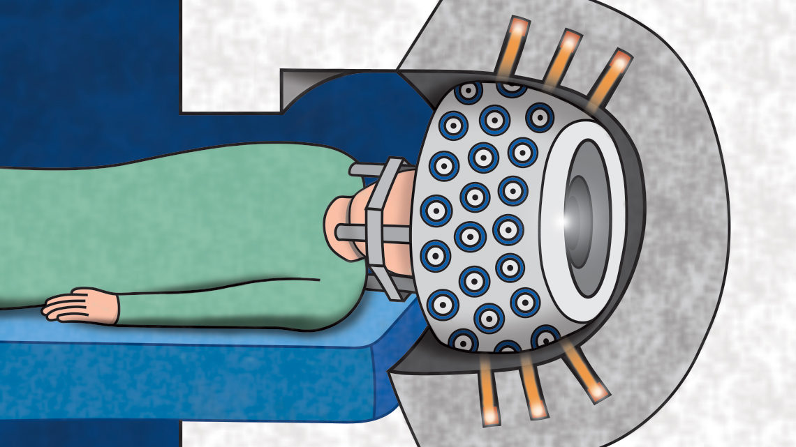 Illustration of someone getting a scan, doctors conduct brain surgery using “gamma ray knives